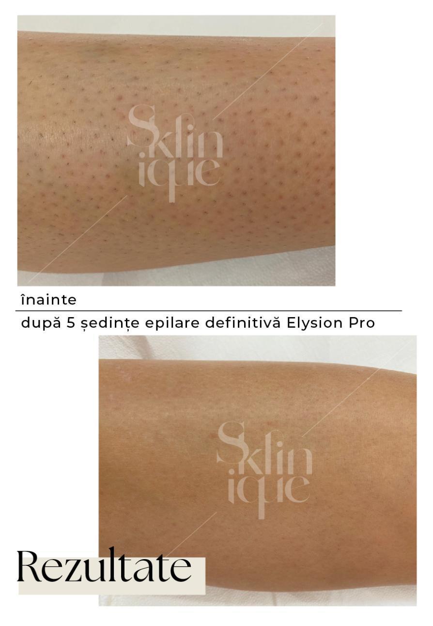 tratament picior scrut