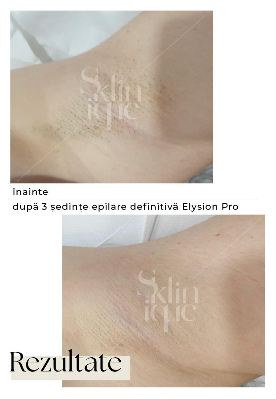 subbrat inainte si dupa