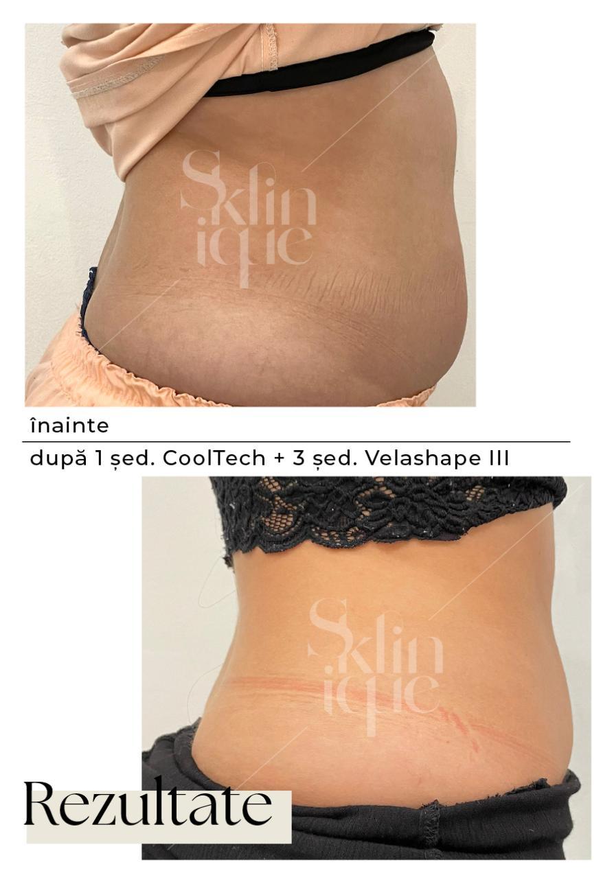 solduri si abdomen din profil rezultate inainte si dupa tratament