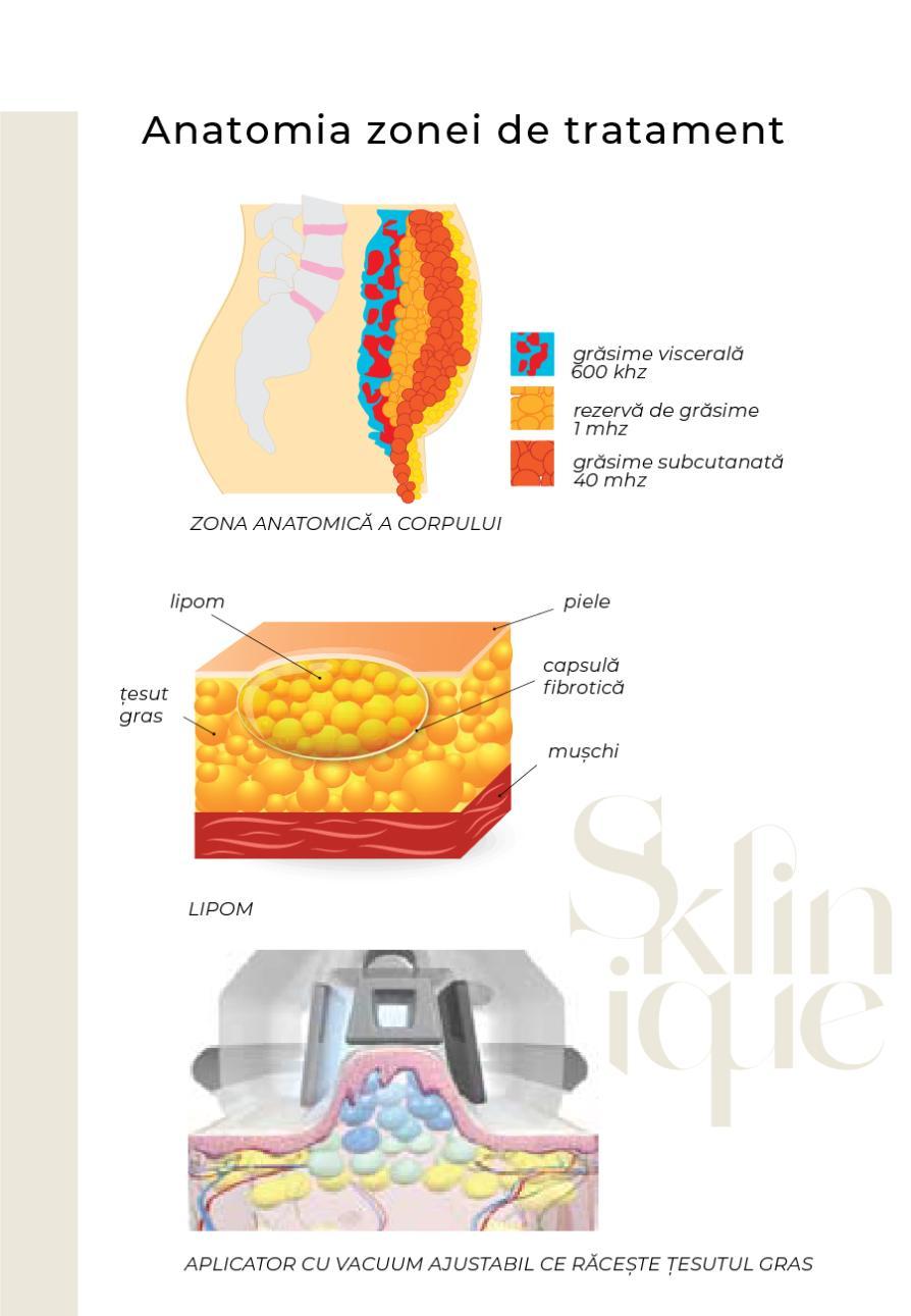explicatie cu straturile de grasimi si cum actioneaza criolipoliza in tesuturi
