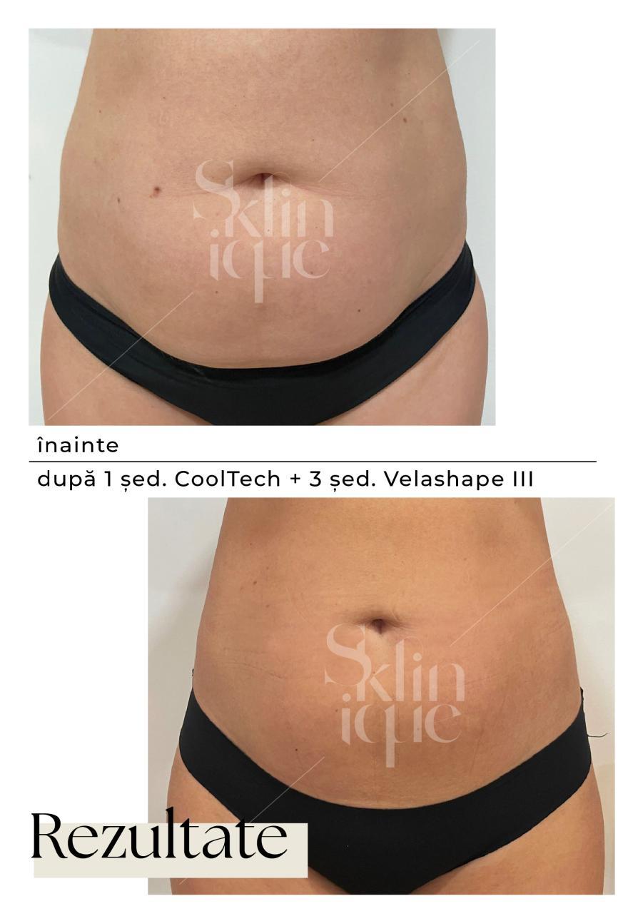 abdomen inainte si dupa tratament