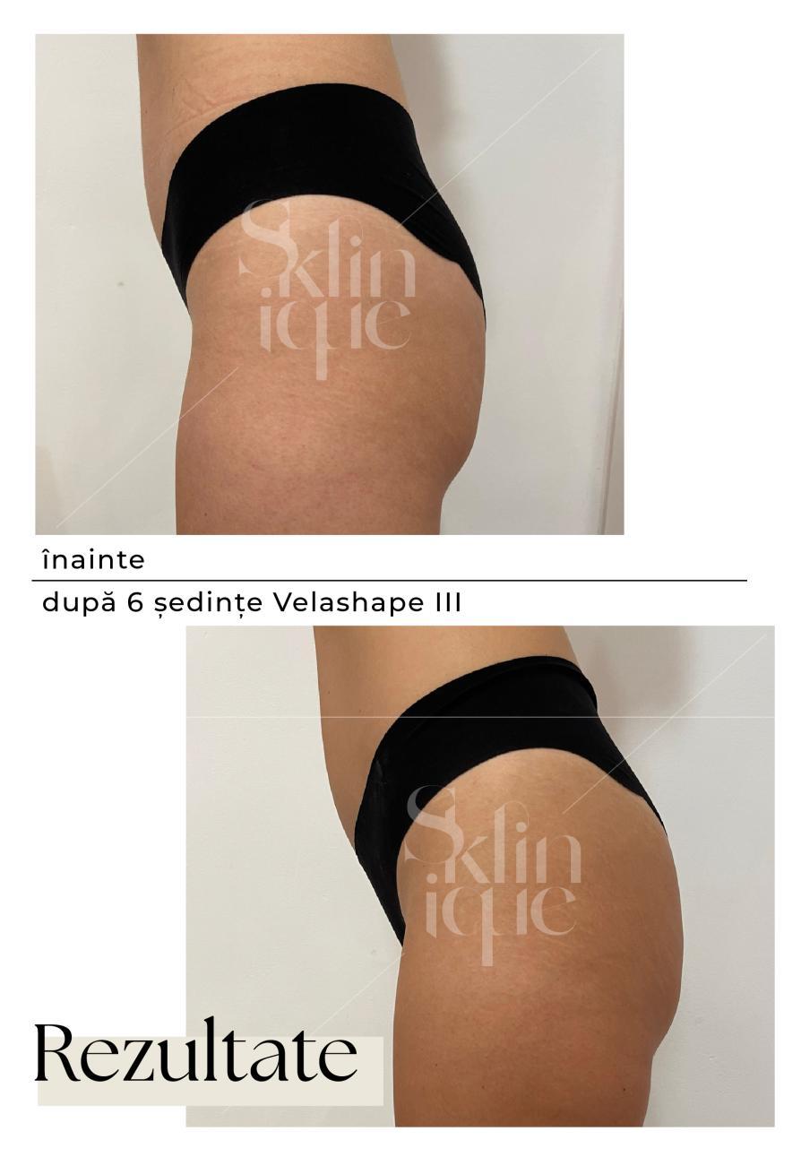 profil sold inainte si dupa tratament velashape 3