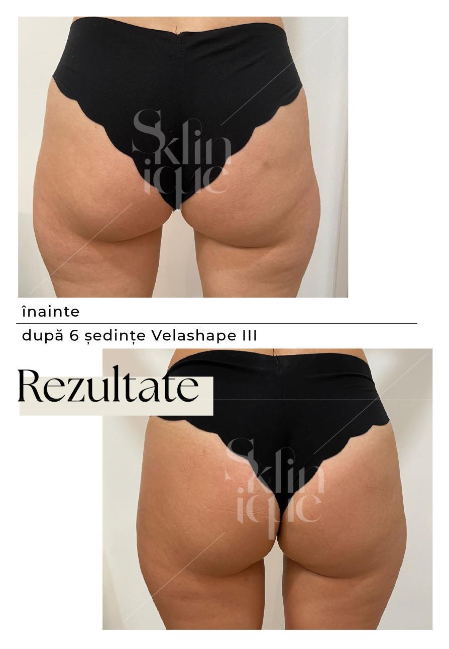 fund inainte si dupa tratament velashape 3