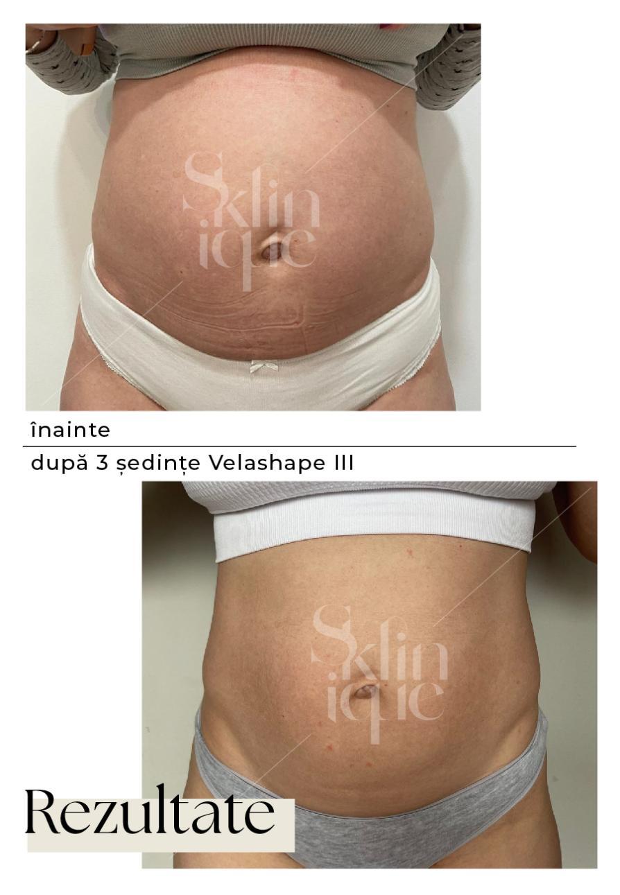 abdomen inainte si dupa tratament velashape 3