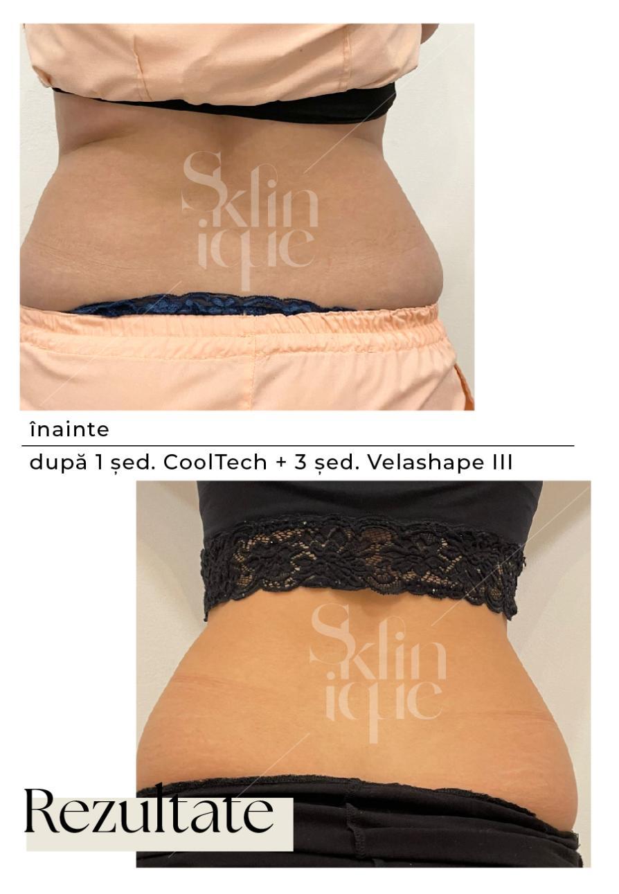 solduri inainte si dupa tratament velashape 3