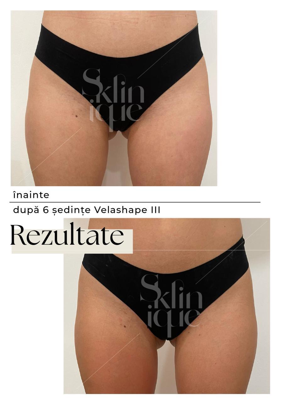 abdomen si coapse inainte si dupa tratament velashape 3